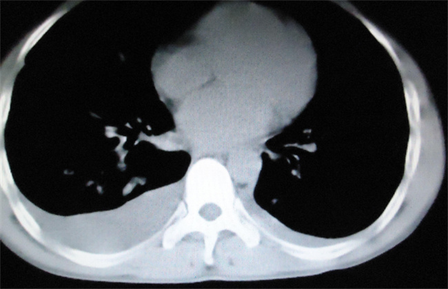 哪些情况需要做肺部CT_什么情况需要做肺部ct